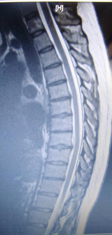 thoracic disc herniation treated by Juneau chiropractor